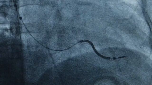 Getting an ICD? Watch an implant procedure! смотреть онлайн