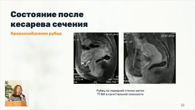 МРТ в оценке рубцовых изменений миометрия Ярнова Е.А. смотреть онлайн