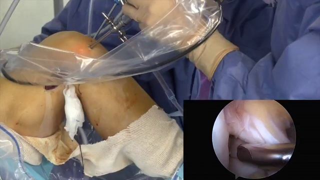 Ligamentoplastie du ligament croisé antérieure du genou type Mc intosh, ou Mac fl au fascia lata смотреть онлайн