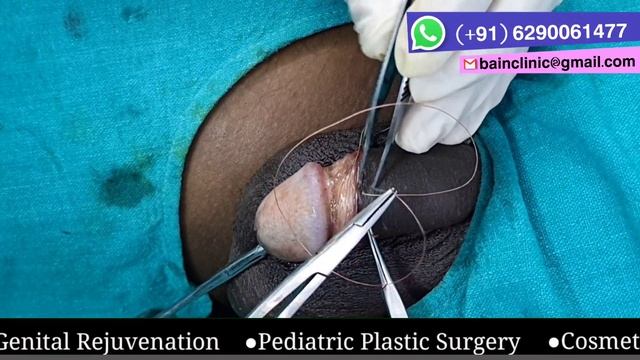 Cosmetic Stitch Circumcision Surgery || Best Circumcision Surgeon In Kolkata