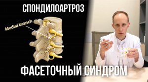 Спондилоартроз. Фасеточный болевой синдром. Блокада и денервация межпозвонковых суставов
