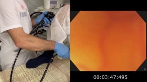 Колоноскопия без наркоза. Квест