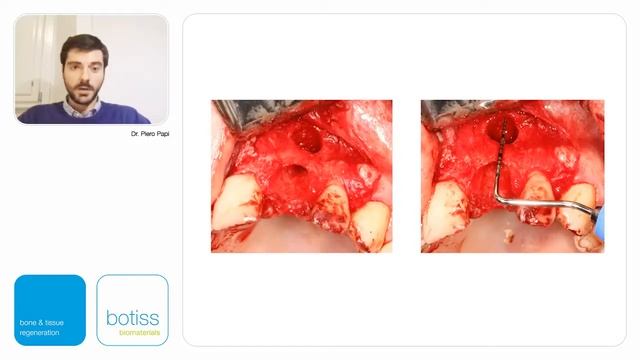 mucoderm® for peri-implant soft tissue augmentation and ridge reconstruction in the aesthetic zone смотреть онлайн