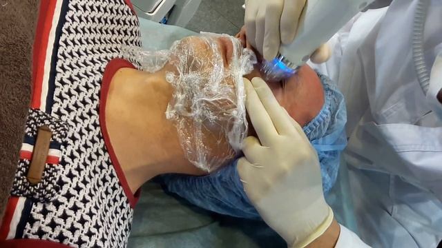 RF лифтинг лица. Безоперационный лифтинг. RF лифтинг - убрать щеки, мешки под глазами смотреть онлайн