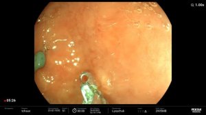 Язвы желудка, биопсия