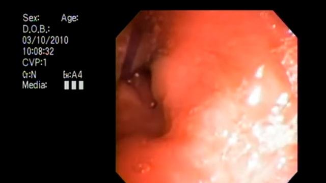 Nerve locator positioning.wmv смотреть онлайн
