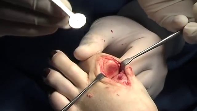 Biomotion Hallux Hemi Arthroplasty Implant Procedure смотреть онлайн