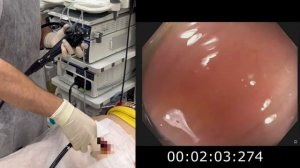 Колоноскопия через колостому.