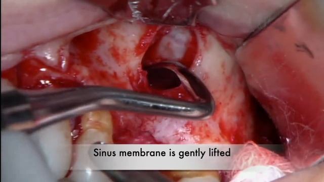 Dental Implant Placement and Sinus Lift Bone Graft in Less Than 30 Minutes смотреть онлайн