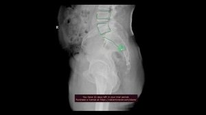 БОЛЬ В КОПЧИКЕ - кокцигодиния. Почему? Симптомы, лечение, разбор рентгена.