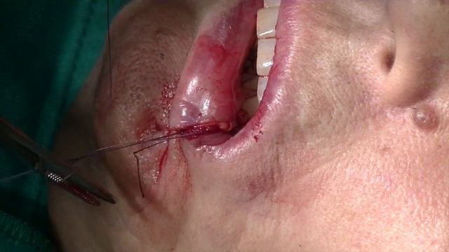 Carcinoma Spinocellulare Labbro inferiore смотреть онлайн