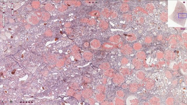 Histopathology - Kidney Amyloidosis смотреть онлайн