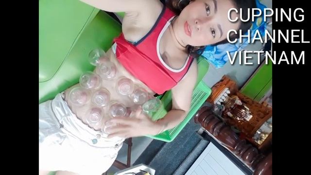 CUPPING CHANNEL VIETNAM,GIÁC HƠI BỤNG. HÚT ĐỘC TỐ, VÀ CÁI KẾT...
