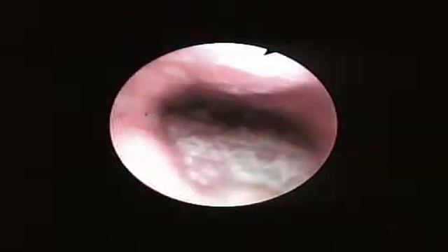 Nasal fiberscope observer+ Oral LMA C Track смотреть онлайн