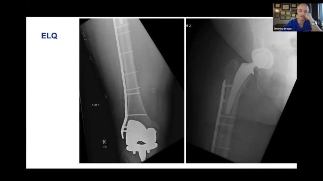 AO Trauma NA Webinar— Periprosthetic Hip/Proximal Femur Fracture Management смотреть онлайн