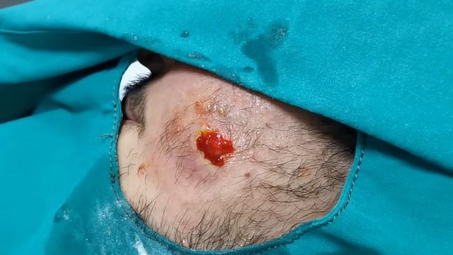 Abcess ( dental origine) - Apse (diş kaynaklı) смотреть онлайн