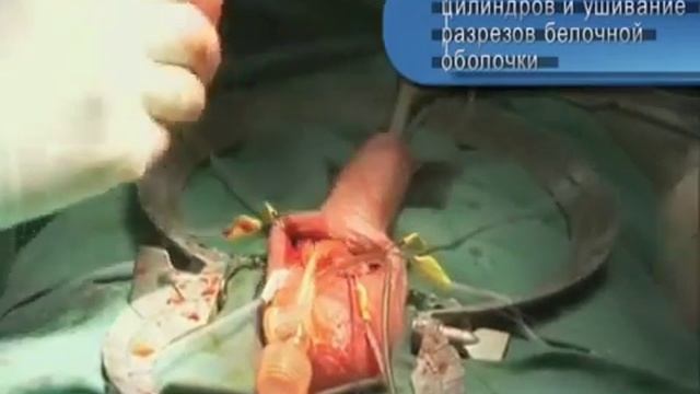 Фаллопротезирование отзывы