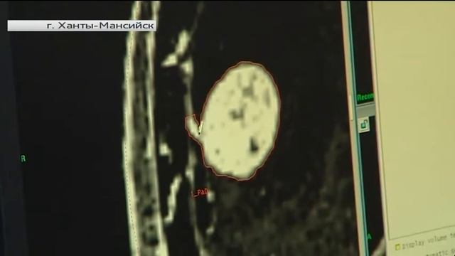 Врачи Ханты-Мансийска провели тысячную операцию на установке «Гамма-нож»