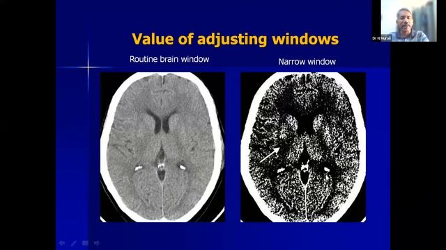 Celebrating International Day of Radiology cum CME on 14.11.2021- Dr N Murali смотреть онлайн