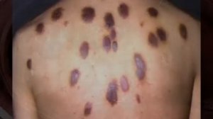 Саркома Капоши