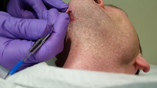 Ingrown Hairs - Four months of growth смотреть онлайн