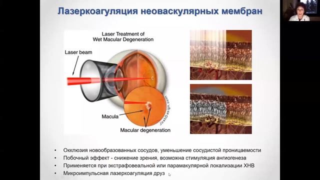 Заболевания сетчатки, осложненные ХНВ смотреть онлайн
