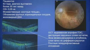 Анатомия и физиология  макулы. Наследственные заболевания сетчатки