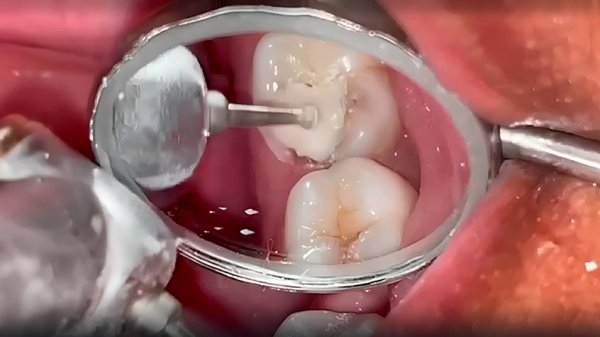 Лечение глубокого кариеса