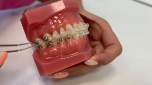 Как вставить дугу в брекет самостоятельно? Инструкция от врача-ортодонта