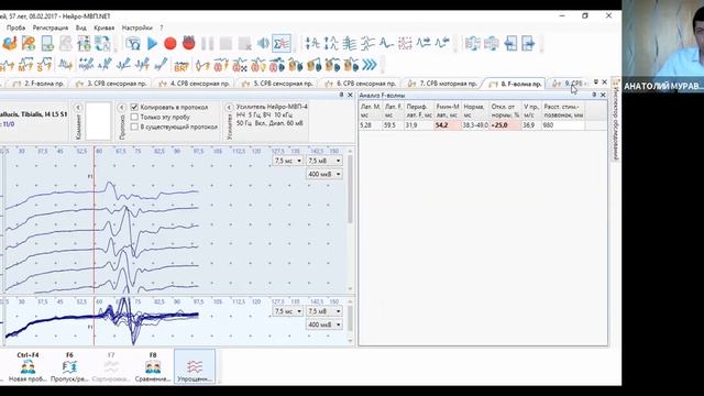 Пример из практики ЭМГ: полиневропатия | Вебинар Нейрософт