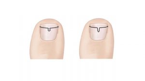 Вросший ноготь без операции. Лечение подологом вросшего ногтя без операции. Подологи МНПЦДК.