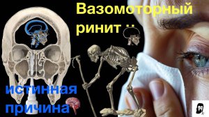 Вазомоторный ринит и ВСД - Противостояние инсультам и его последствия