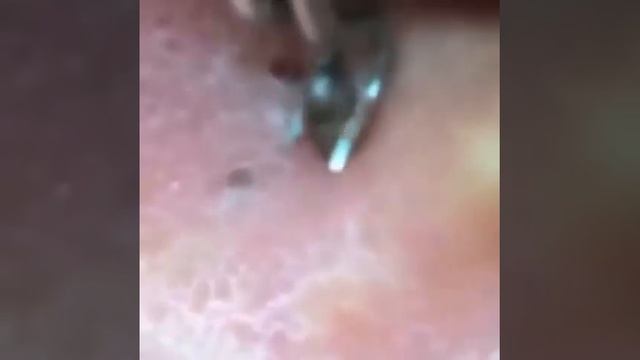 Чистка пор уха #1 смотреть онлайн