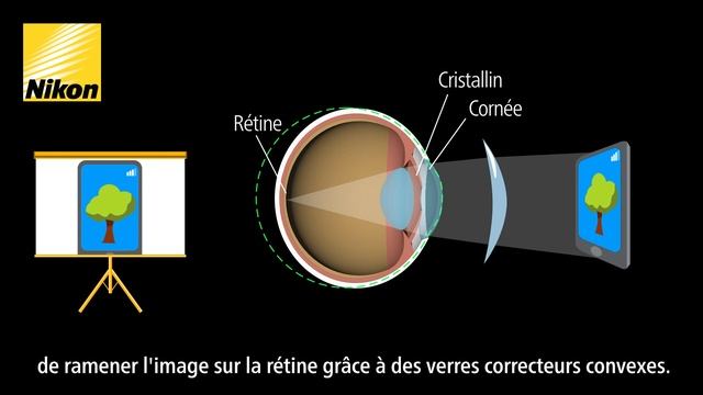 Comment corriger l'hypermétropie ? смотреть онлайн