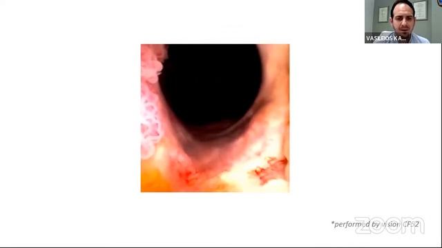 Portable Flexible Cystoscopy in Office——Greece Experience смотреть онлайн