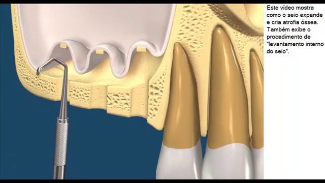 Atrofia ossea e enxertia Atrofia Seio Maxilar e Enxertia Levantamento Interno do Seio com 3 Imp смотреть онлайн