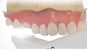 Процесс установки импланта