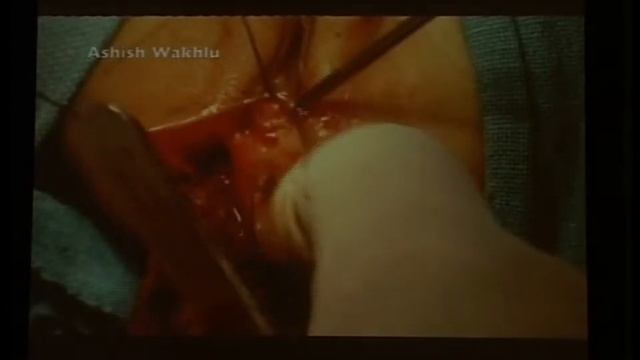 ASARP in low anal anomalies in female children смотреть онлайн