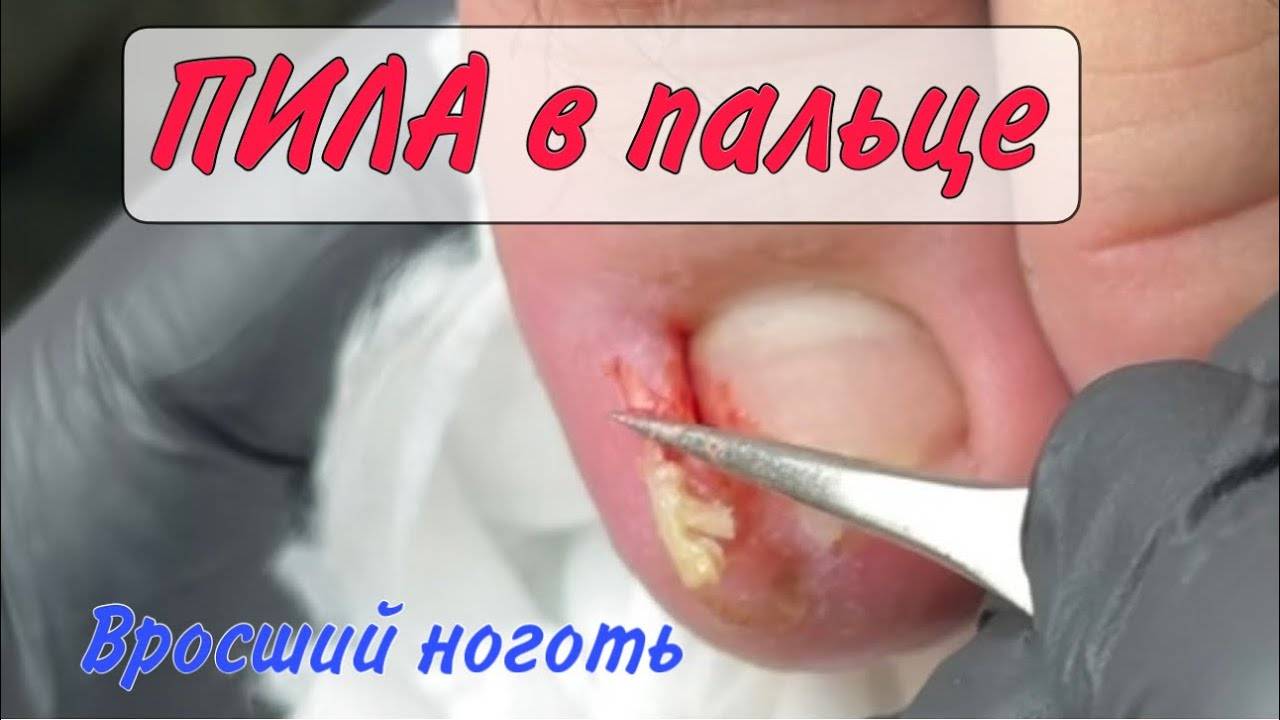 Сложный вросший ноготь _ как убрать вросший ноготь _ врастающий ноготь в кожу _ подолог Москва смотреть онлайн
