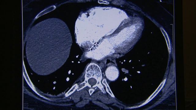 Dr. Engelhardt Treatment for Pulmonary Embolism-Windows Media Player Export.wmv смотреть онлайн