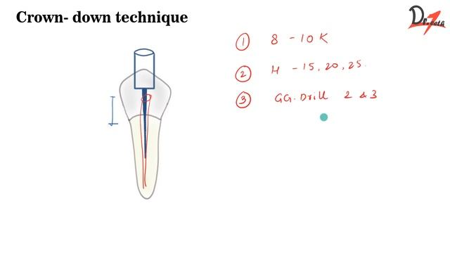 Crown- Down Technique| ENDODONTICS |