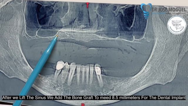 Sinus Lift Dental Implants In Mexico смотреть онлайн