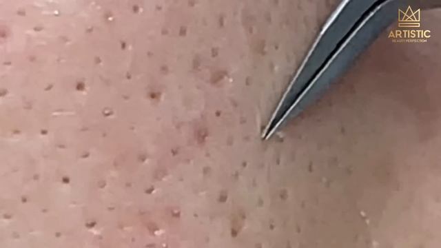 กดสิว Blackheads Filaments On Nose Remove With Tweezers