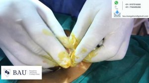 ZSR Circumcision in children / Stitchless Circumcision in Bangalore