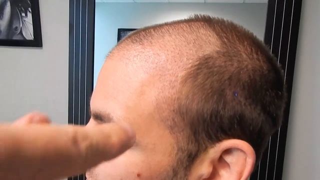 Hair Transplant Before and After - Orlando, Central Florida Best Hair Transplants (Steve) смотреть онлайн