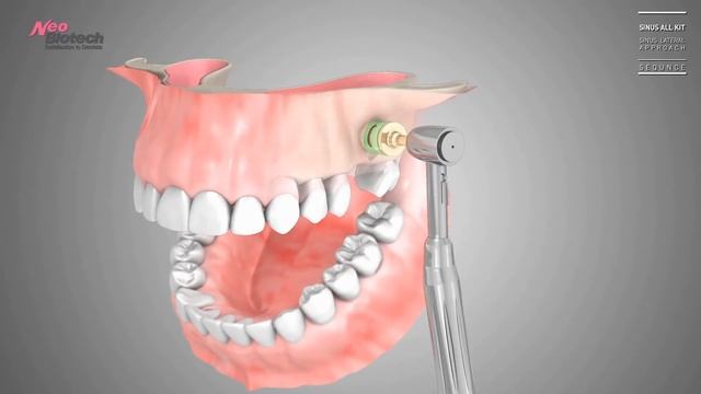 Sinus Lift: Sinus All Kit (No Window Core) смотреть онлайн