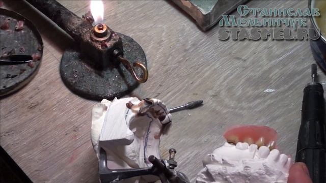 ЗУБНОЙ ПРОТЕЗ. Коронки с выраженным экватором. Продолжение - Подготовка к перебазировке протеза смотреть онлайн