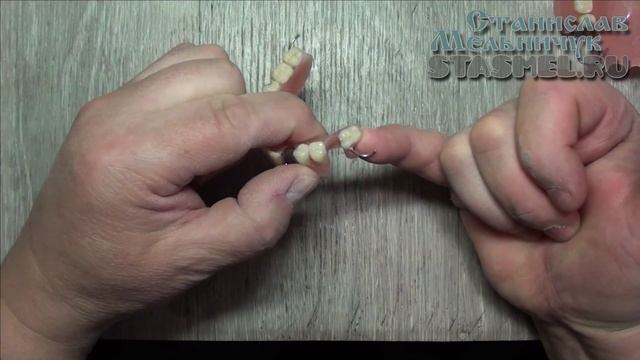 ЗУБНЫЕ ПРОТЕЗЫ. Необычное решение с нижним протезом. смотреть онлайн