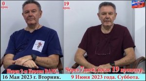 № 1185. Б.Паркинсона. Изменения внешности при лечении Методом RANC.