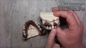 ЗУБНЫЕ ПРОТЕЗЫ. Сколько и каких зубов ставить на съёмный протез.